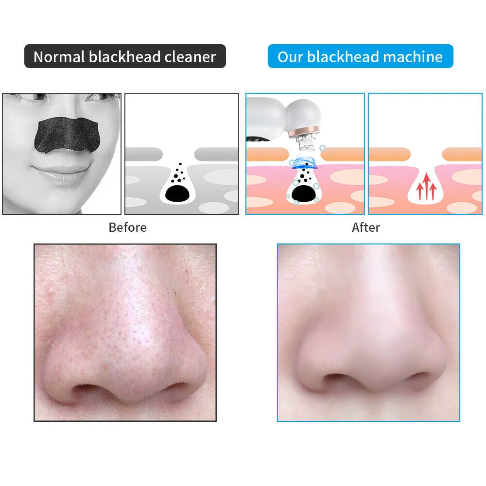 New Blackhead Remover Vacuum Suction Personal Care Small Bubble Electric Face Nose Cleaner